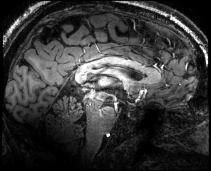 skleroza zdravljenja možganskih žil