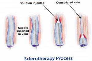 pregledi za skleroterapijo