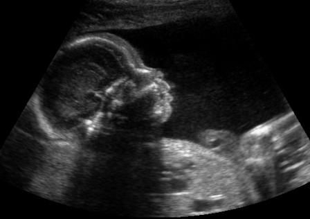 ултразвуково изследване по време на бременност