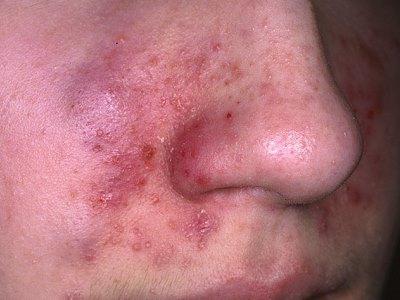 Seborrhea лицето лечение