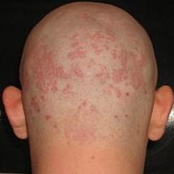 povzroči seboroični dermatitis