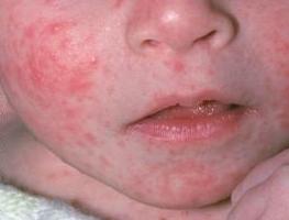 seboroická dermatitida ošetření obličeje