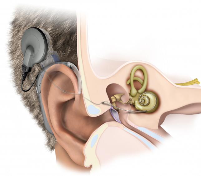 perdita dell'udito neurosensoriale 3 gradi