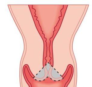 cervice corto durante il trattamento della gravidanza