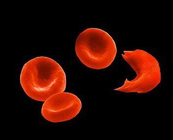 anemiju srpastih stanica