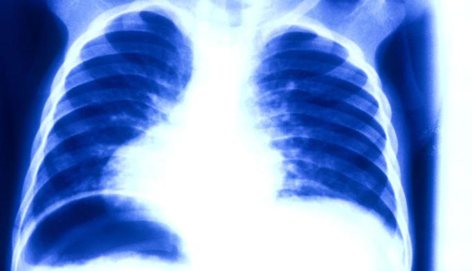 malattia di bronchite