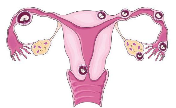 pierwsze objawy ciąży pozamacicznej