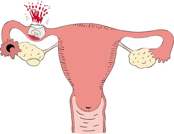 come determinare la gravidanza ectopica