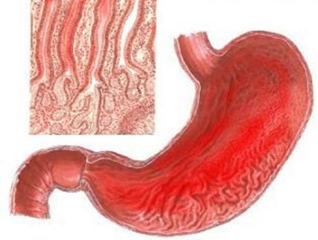 simptomi liječenja gastritisa u želucu