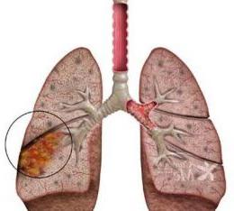 Zapalenie płuc, co to jest