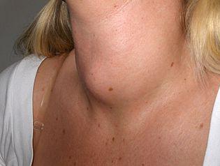 segni di malattia della tiroide