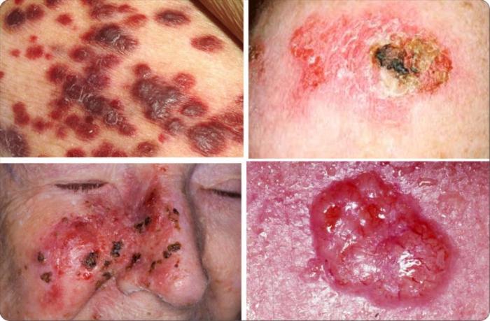 Typy rakoviny kůže