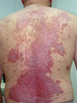 Liječenje kandidijaze na koži