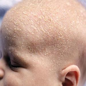pregledi kožnih šamponov za kožo