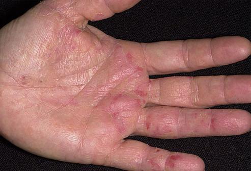 kožne bolezni na rokah