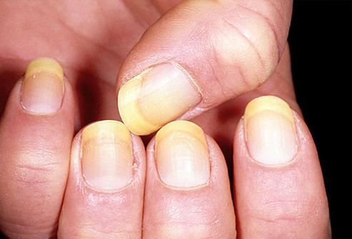kožní onemocnění na prstech