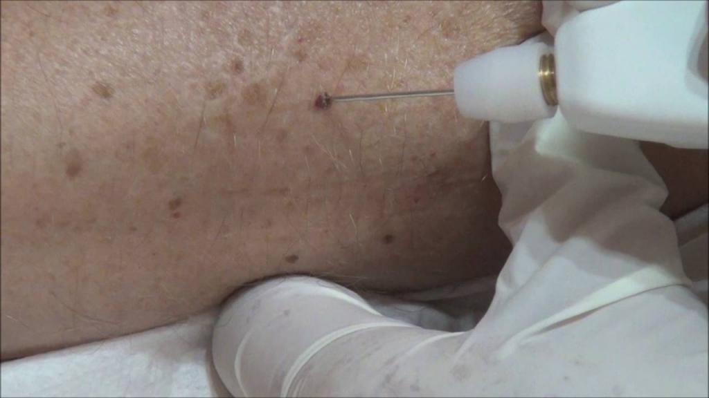 Kauterizacija hemangioma na koži