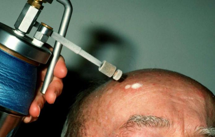 léčba keratózy na pokožce hlavy