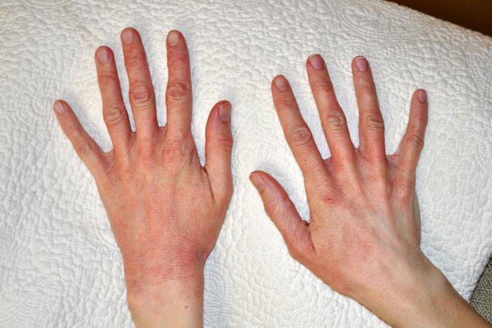 fotografija sončnega dermatitisa