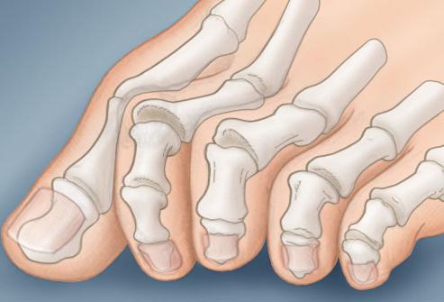 duży ból palca u nogi boli