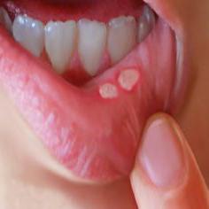 bolest v ústech bílá, jak se léčit