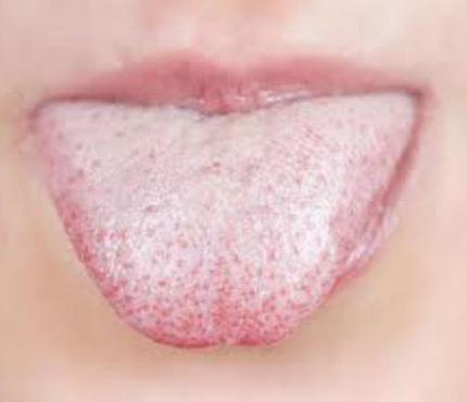 kako zdraviti rane v ustih