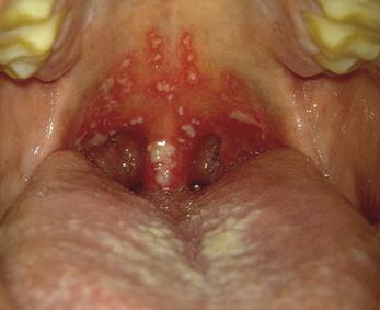 liječenje rana u ustima