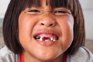koliko boli zub nakon uklanjanja
