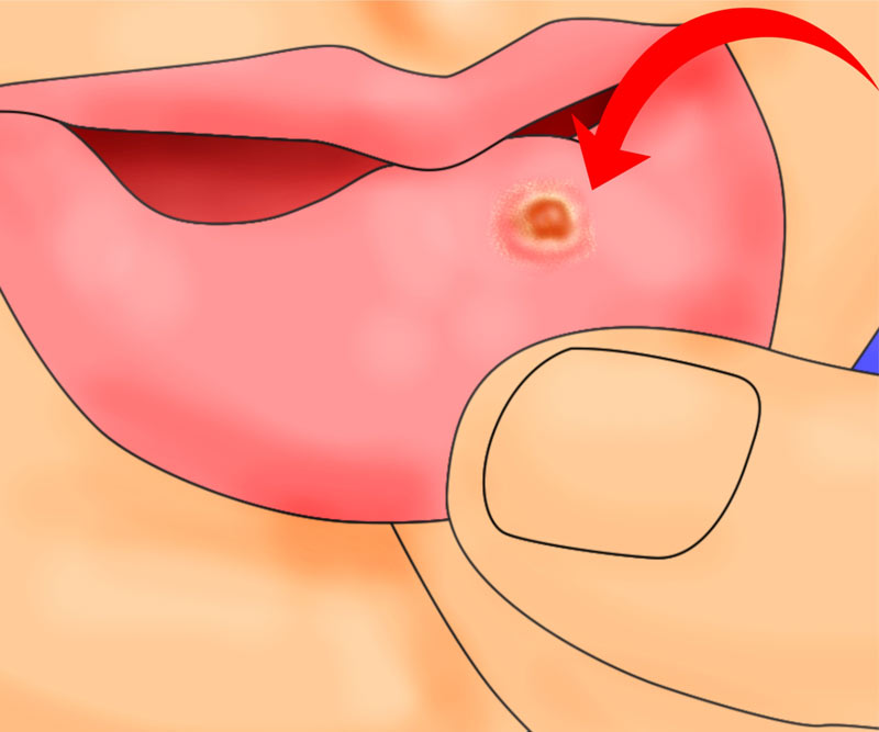 как да се лекуват раните в устата