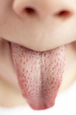 što liječiti čireve usta