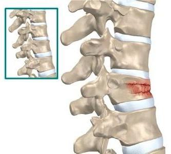 sintomi di frattura da compressione spinale