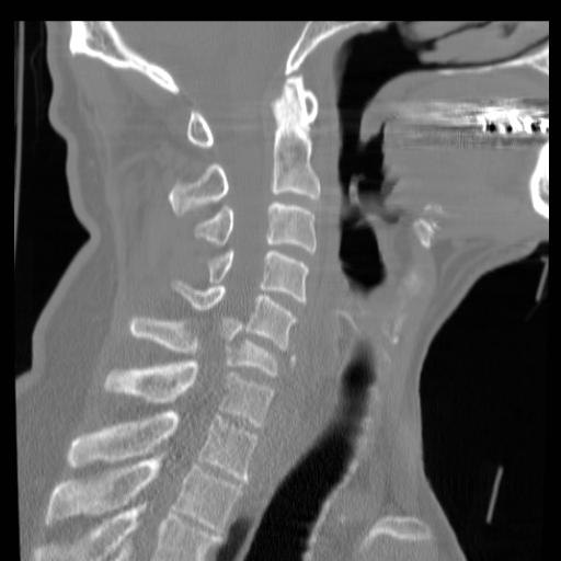 Frattura di compressione della colonna vertebrale toracica