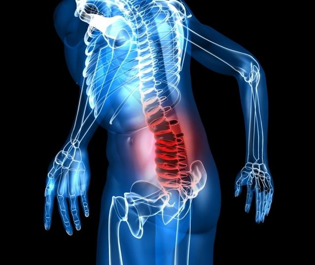 sintomi di ernia spinale