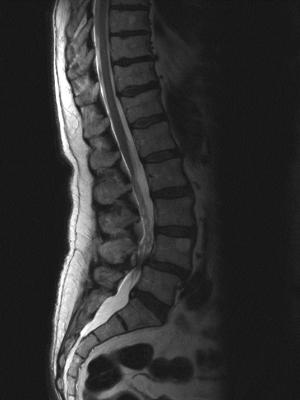 Léčba spinální stenózy