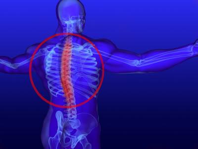 liječenje spinalne kifoze