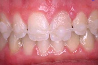 zubní dlahy
