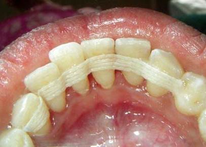 denti che si stagliano con recensioni della malattia parodontale