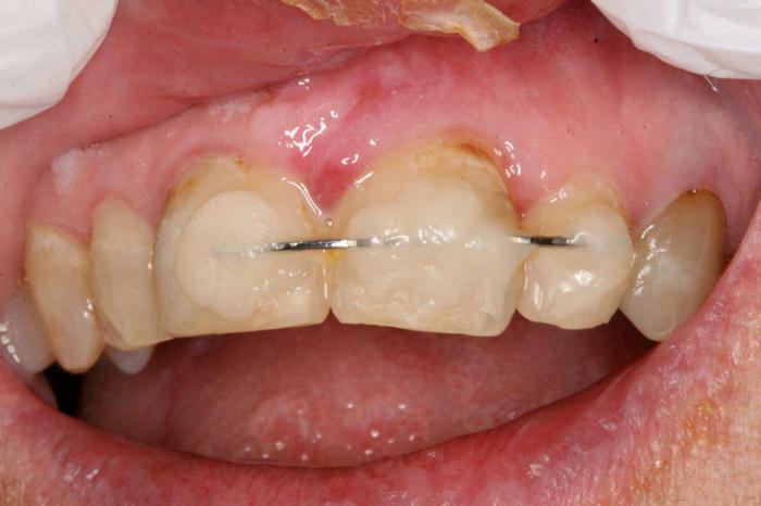 denti che splintano per la paradontosi
