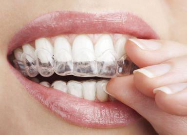 шиниране на подвижни зъби