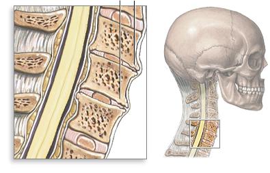 spondiloza vratne hrbtenice