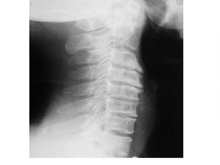 osteochondrosis spondylosis kręgosłupa szyjnego