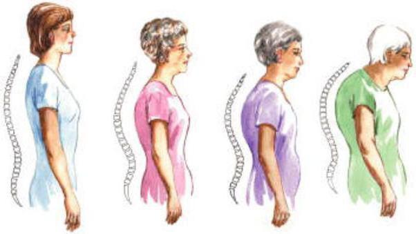 deformirajoča spondiloza prsne hrbtenice
