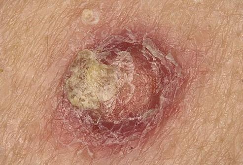 Rak na skvamozni koži