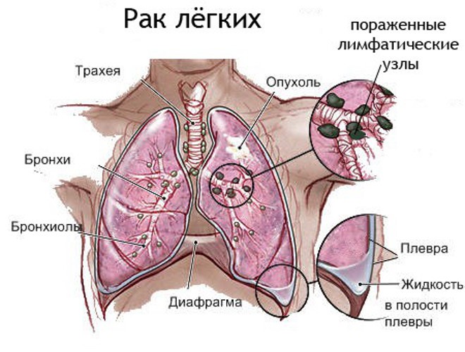 Рак на белия дроб