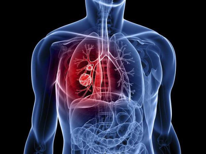 przerzuty raka płuc, ilu żyć