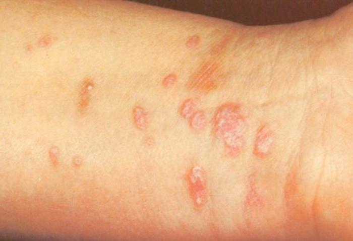 alergii skórnych czerwone plamy