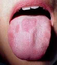 Macchie sulla lingua