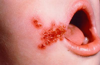 Simptomi Staphylococcus aureusa pri otrocih