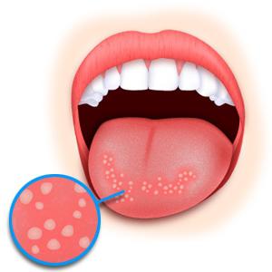 zapalenie jamy ustnej niż leczyć