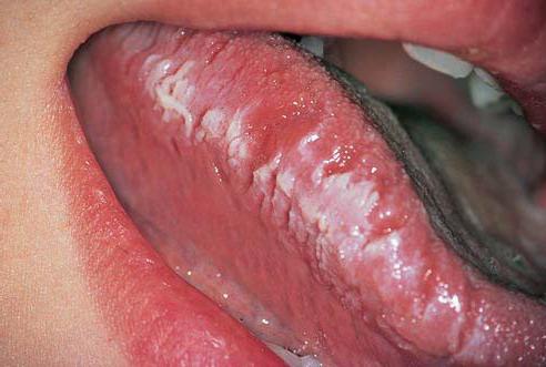 stomatitis na jeziku
